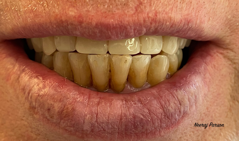 dental implants treatment in salisbury